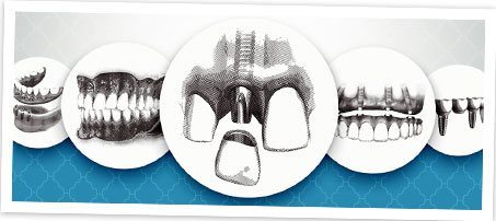 Series of sketches for dental implant placement