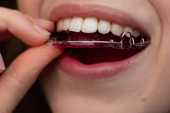 woman putting on retainer 