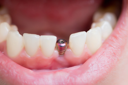 person smiling with dental implants